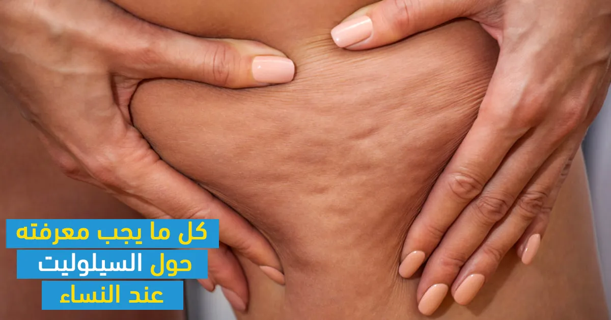 كل ما يجب معرفته حول السيلوليت عند النساء